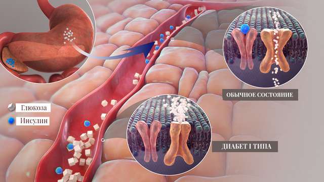 Диабет 1 типа не смертельно, хотя и не лечится